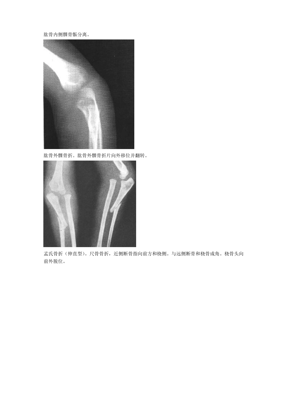 骨折图片大全_第3页