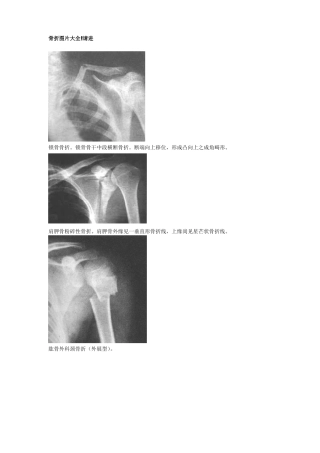 骨折图片大全