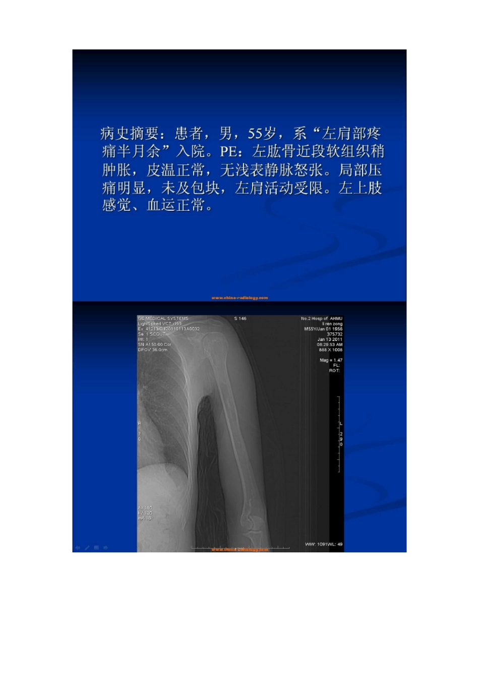骨纤维结构不良已自动恢复_第3页