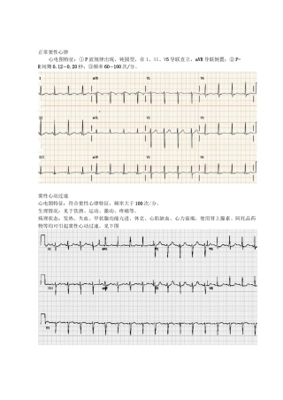 异常心电图识别
