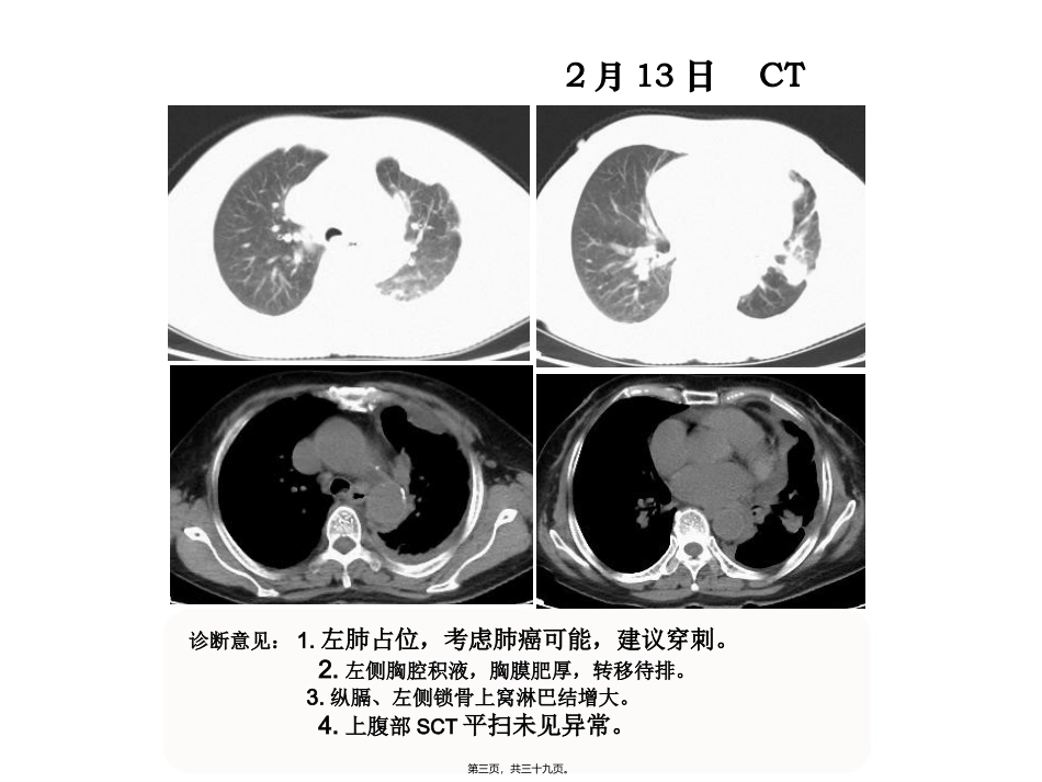癌痛标准化治疗癌痛病例分享教学培训课件_第3页