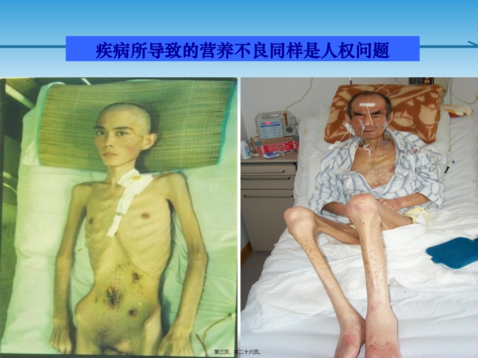 肠内营养的实施与监测 讲座课件_第3页