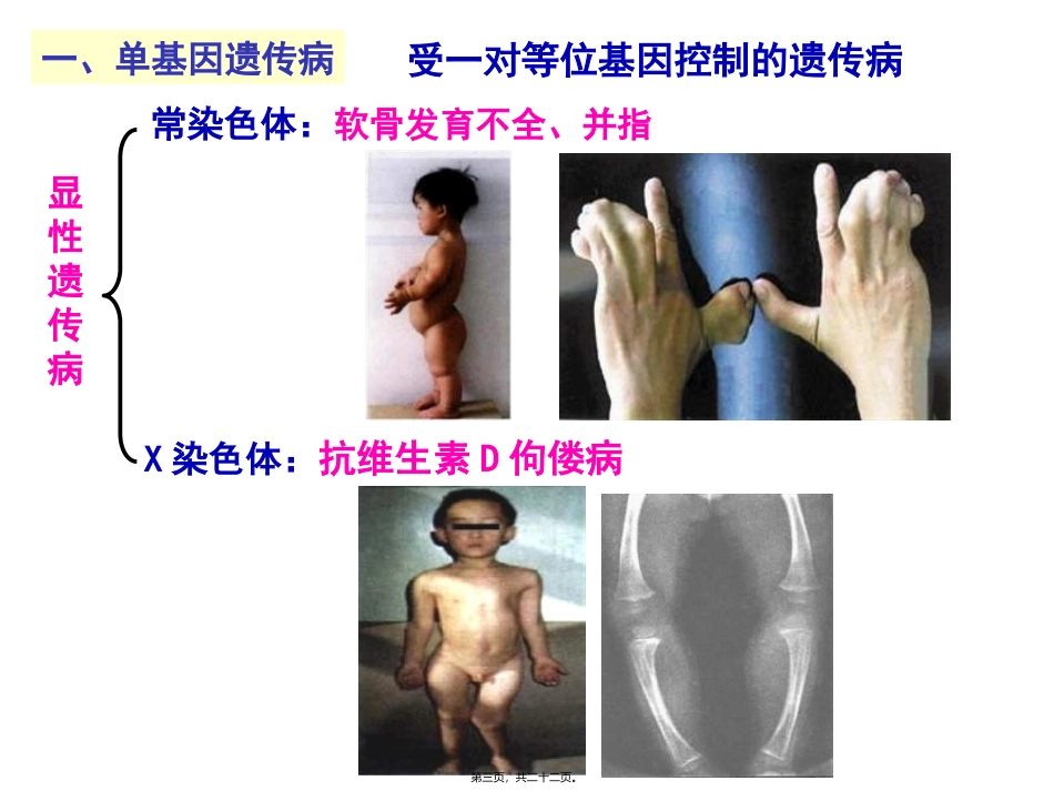 第五章第三节人类遗传病与优生 教学课件_第3页