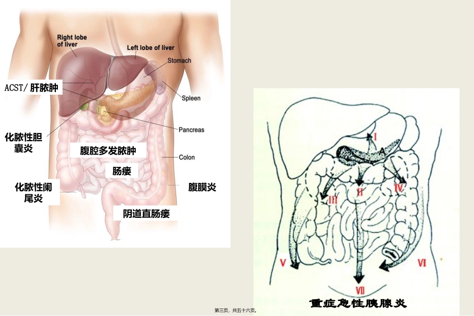 复杂性腹腔感染的处理 医学教学课件_第3页