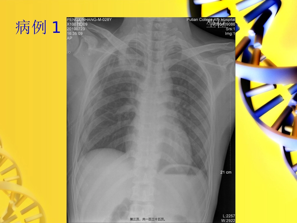 《肺结核病例讨论分析》培训课件_第3页