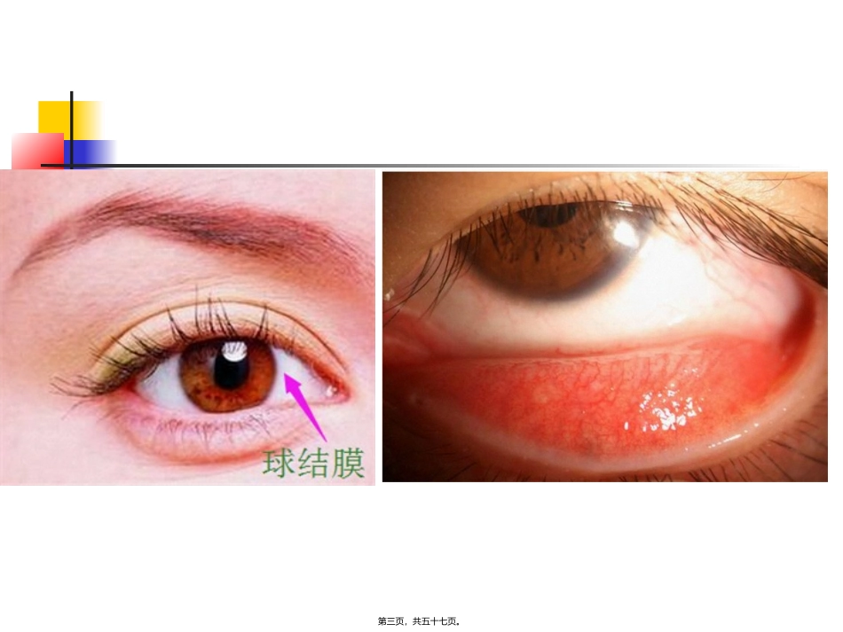 结膜病 医学教学课件_第3页
