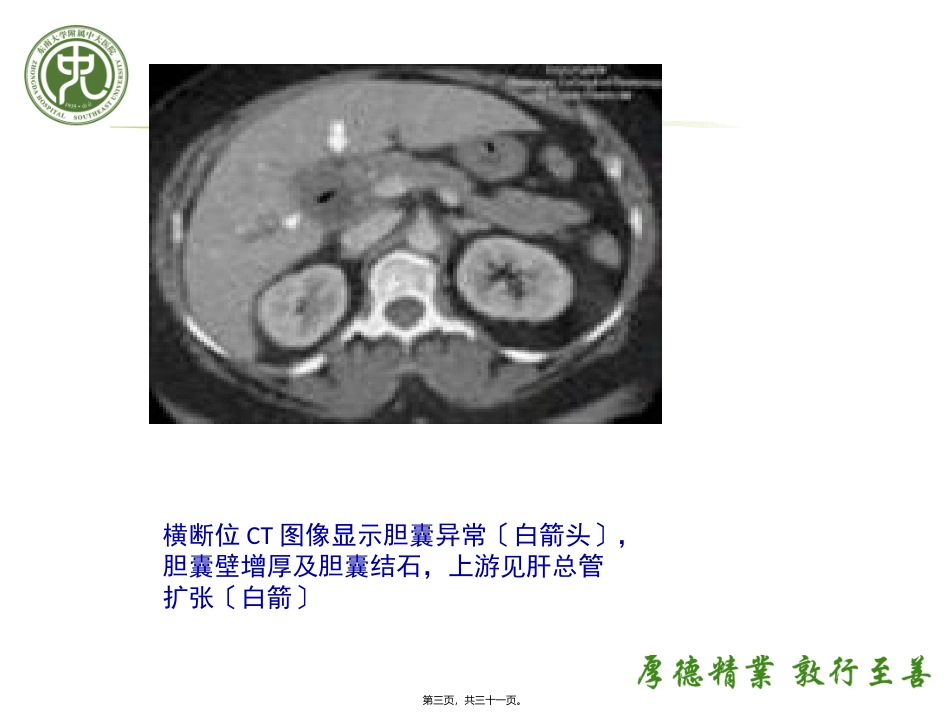 Mirizzi综合症(米利兹综合征)(肝管狭窄综合症)_第3页