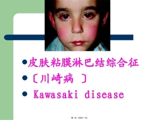 川崎病皮肤粘膜淋巴结综合征 医学培训讲座课件