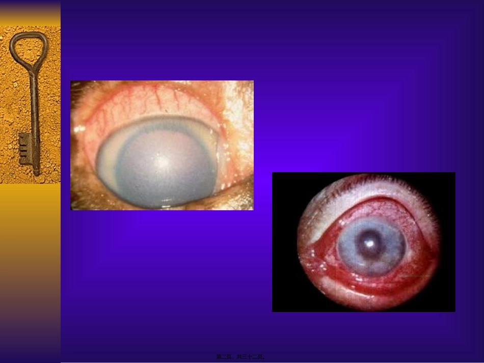 医学教学培训课件 青光眼_第2页