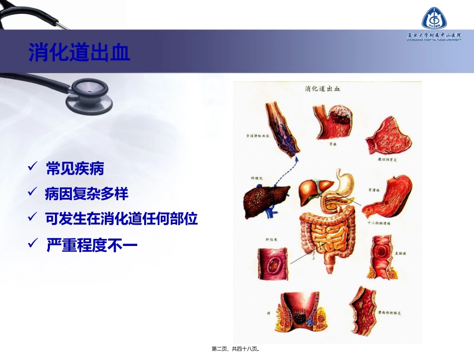 不明原因消化道出血的诊疗进展_第2页