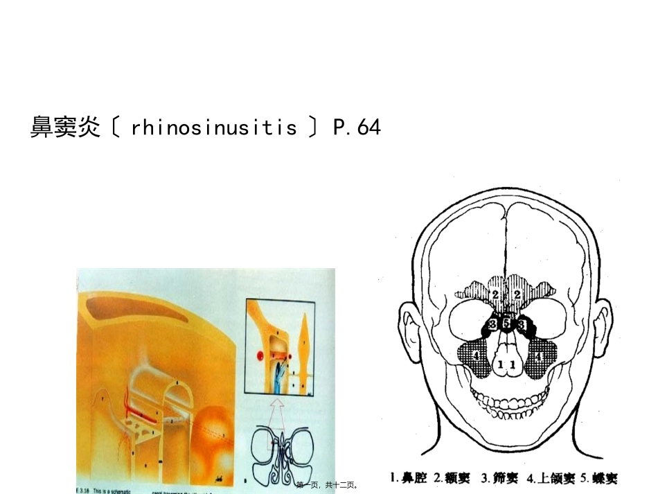 医学培训课件 鼻窦炎_第1页