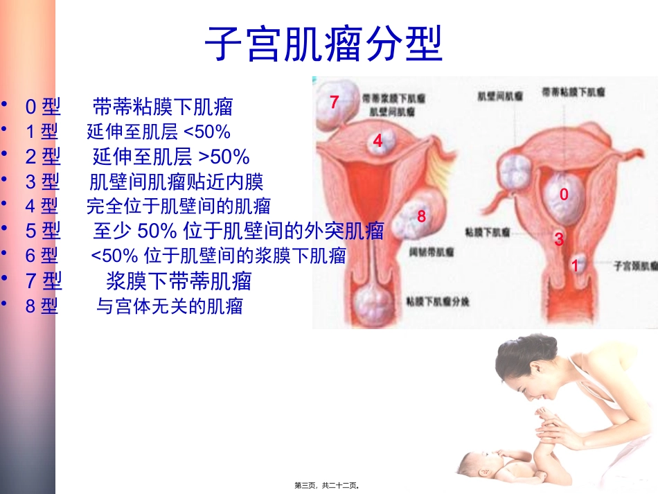 不孕妇女子宫肌瘤的处理策略_第3页