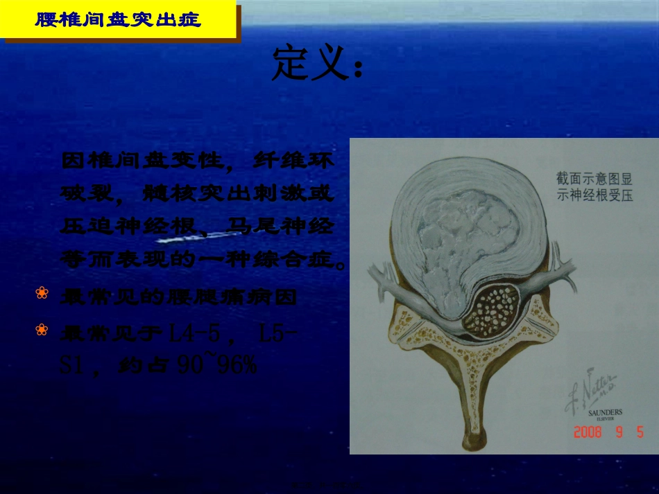 椎间盘突出症医学教学课件_第2页