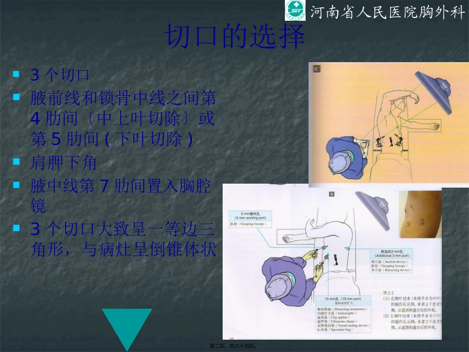 VATS肺叶切除_第2页