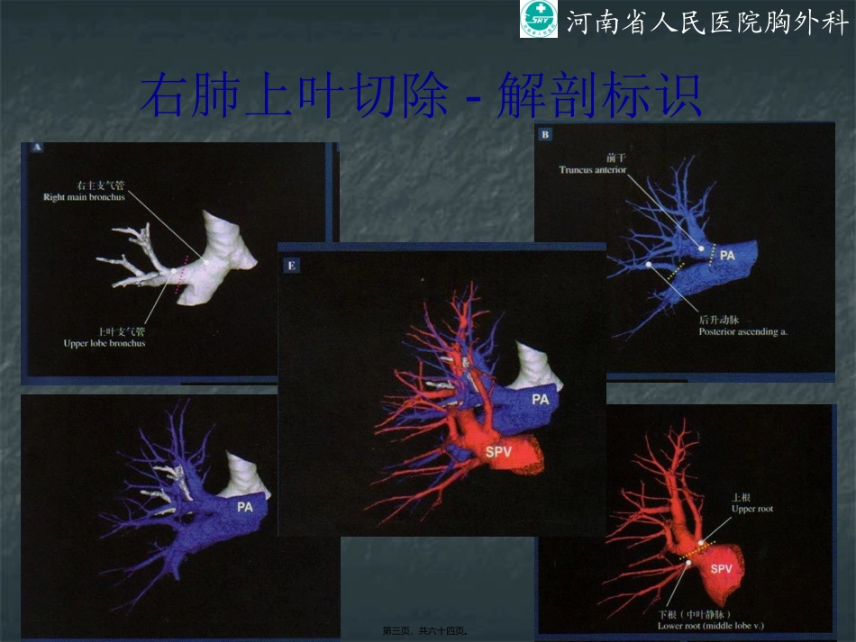 VATS肺叶切除_第3页
