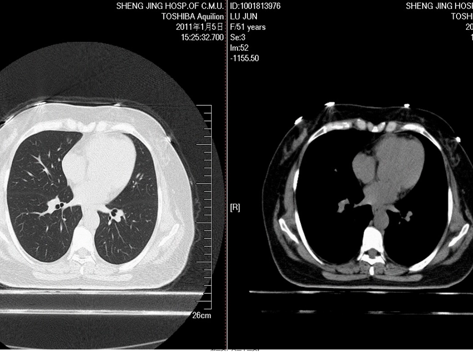 NCCN肺癌筛查指南2012版_第3页