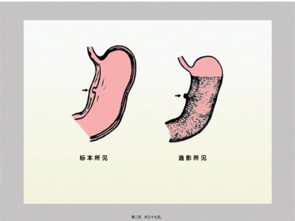 胃肠道异常X-线表现 医学教学设计_第2页
