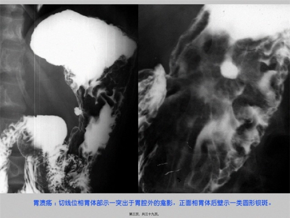 胃肠道异常X-线表现 医学教学设计_第3页