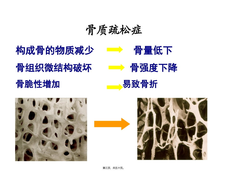 原发性骨质疏松症 医学教学培训课件_第3页