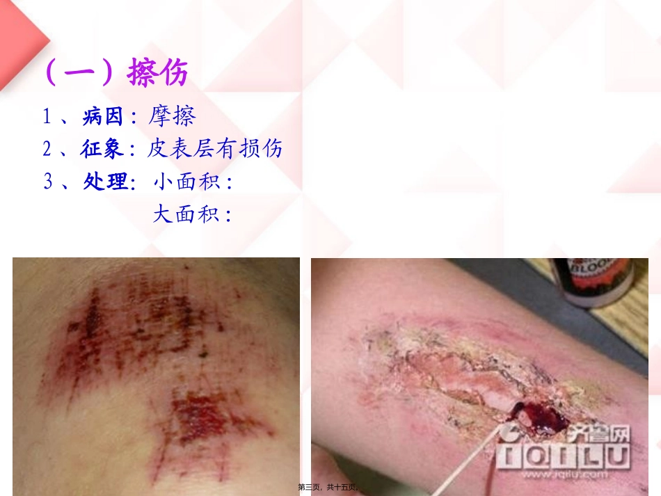 运动中常见损伤的处理和急救 培训讲座课件_第3页