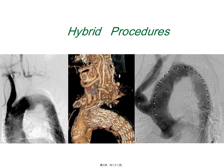 主动脉弓复杂病变--HybridChmneyorelse 医学教学课件_第3页