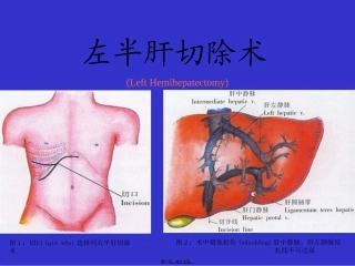 2022年医学专题—左半肝切除术1汇总