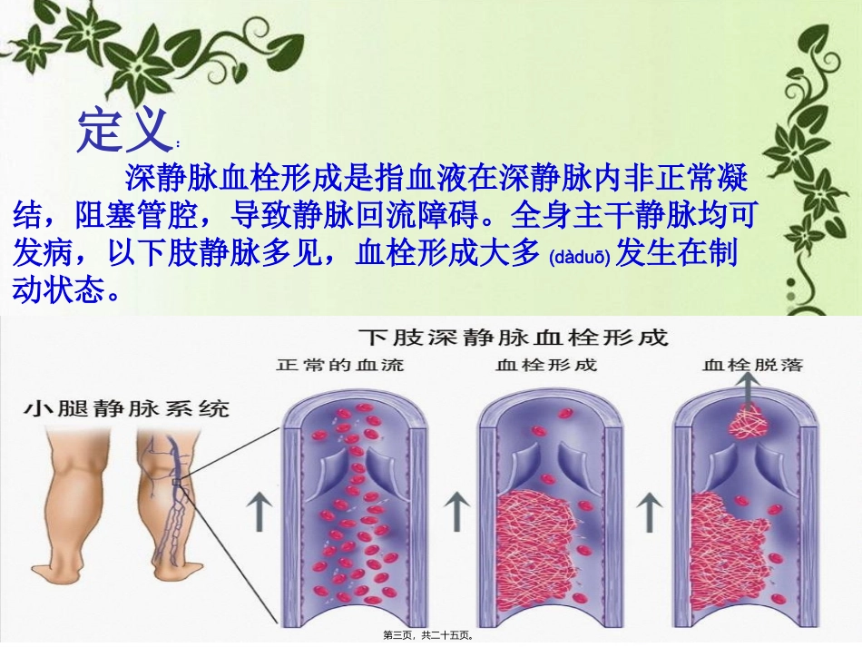 2022年医学专题—左下肢静脉血栓的疑难病例讨论_第3页