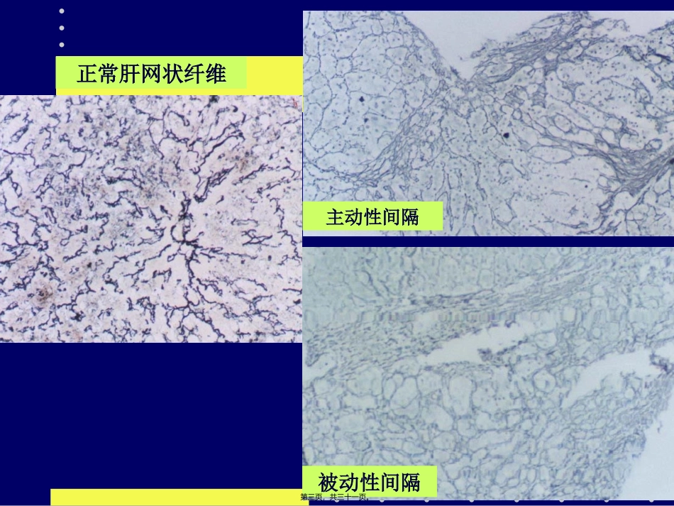 8消化2009-5-8肝硬化_第3页