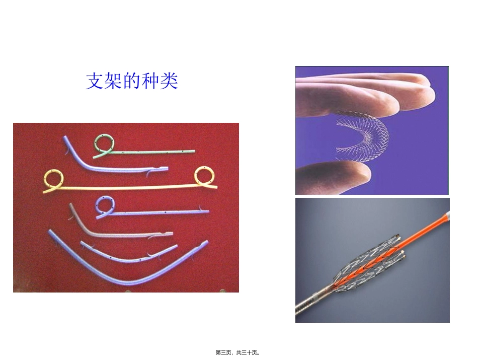 ERCP下胆道胰管支架置入讲述_第3页