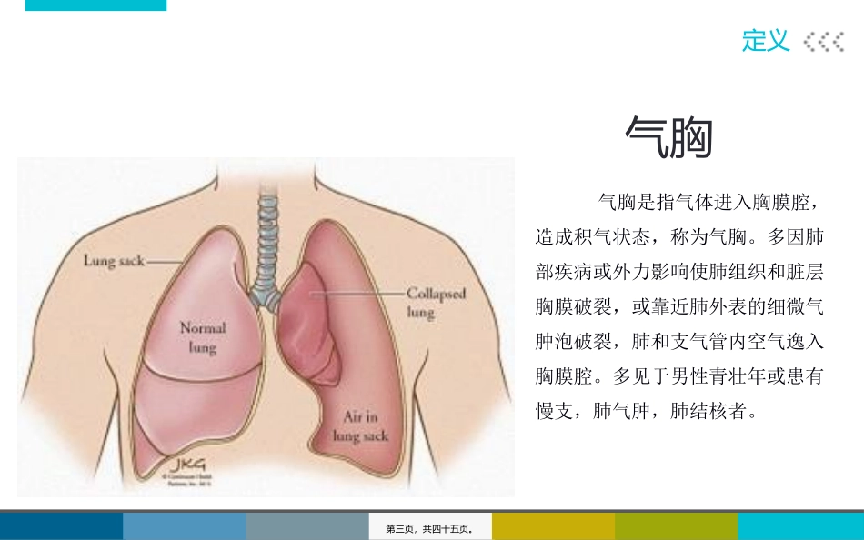 Ⅱ型呼衰合并气胸个案2_第3页