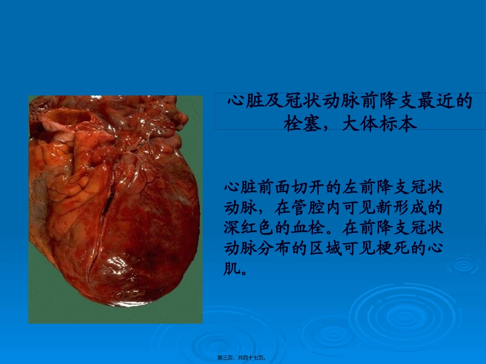 64层螺旋CT冠脉成像_第3页