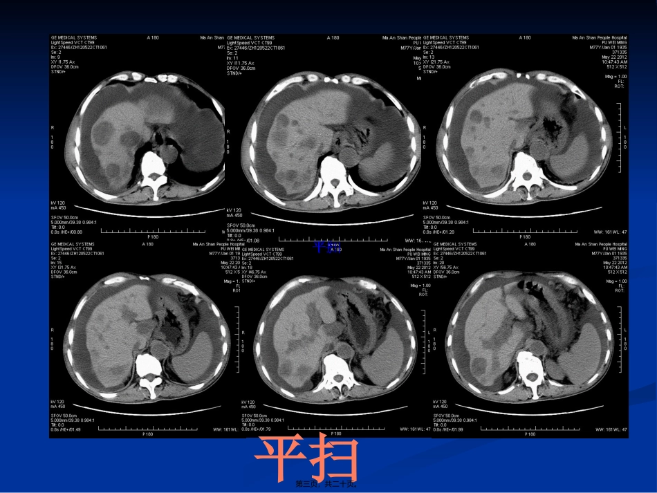 AFP阳性胃癌_第3页