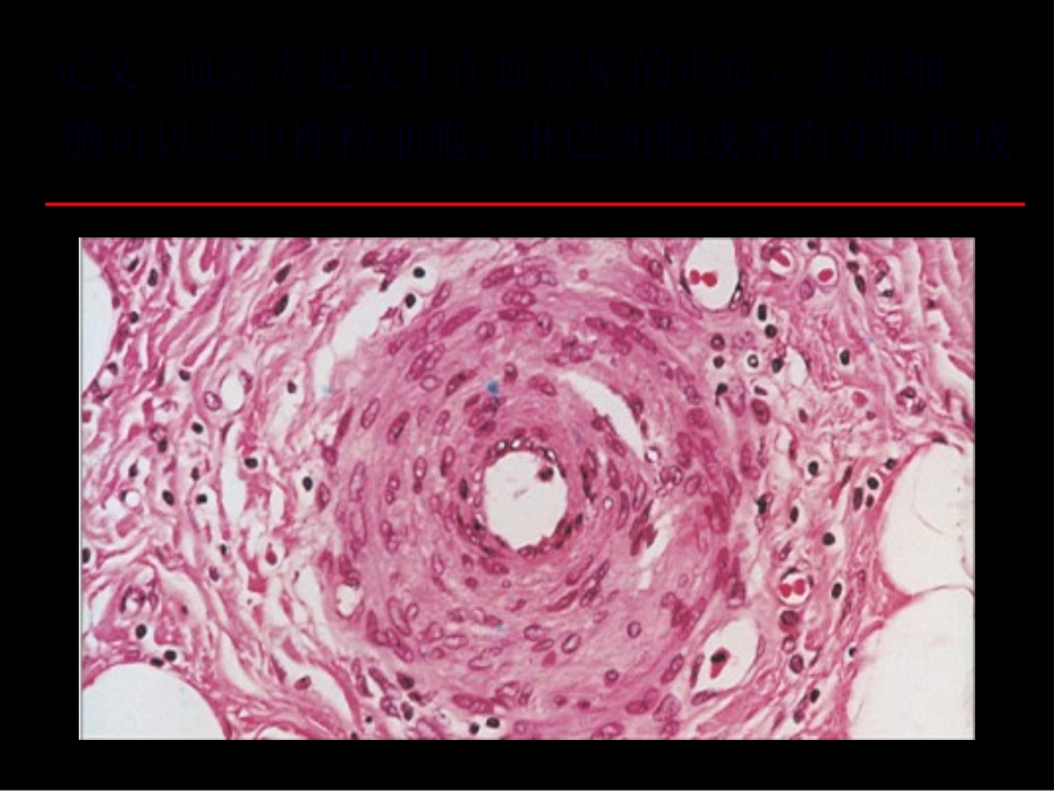ANCA相关小血管炎_第3页