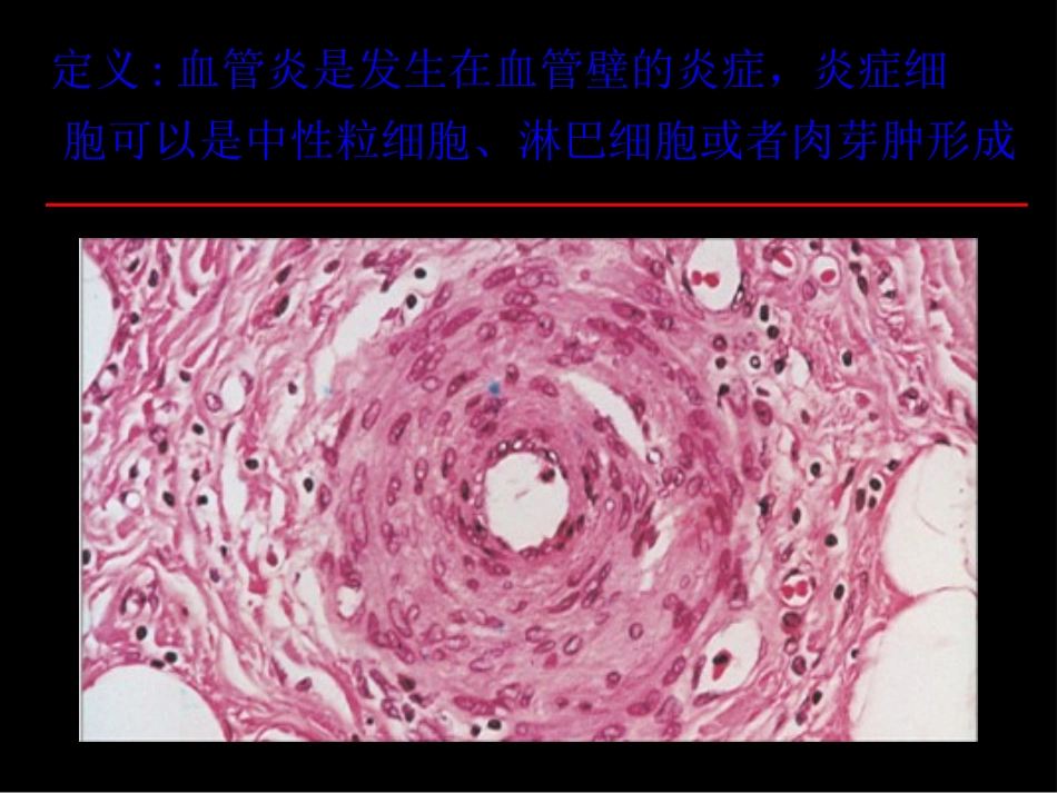 ANCA相关小血管炎0-(AAV)amx2_第3页