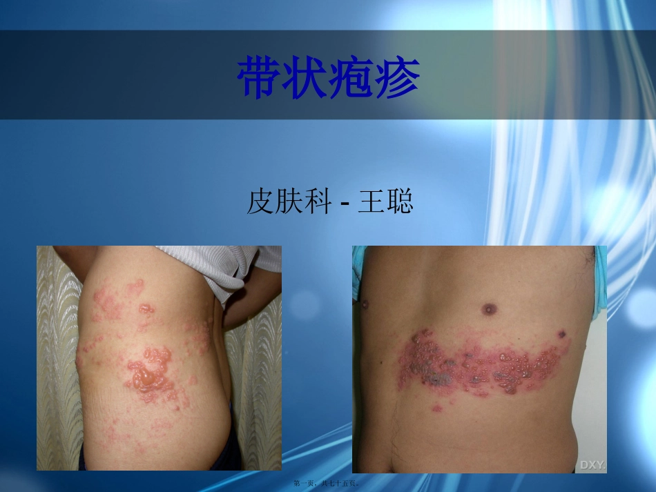 带状疱疹精讲版_第1页