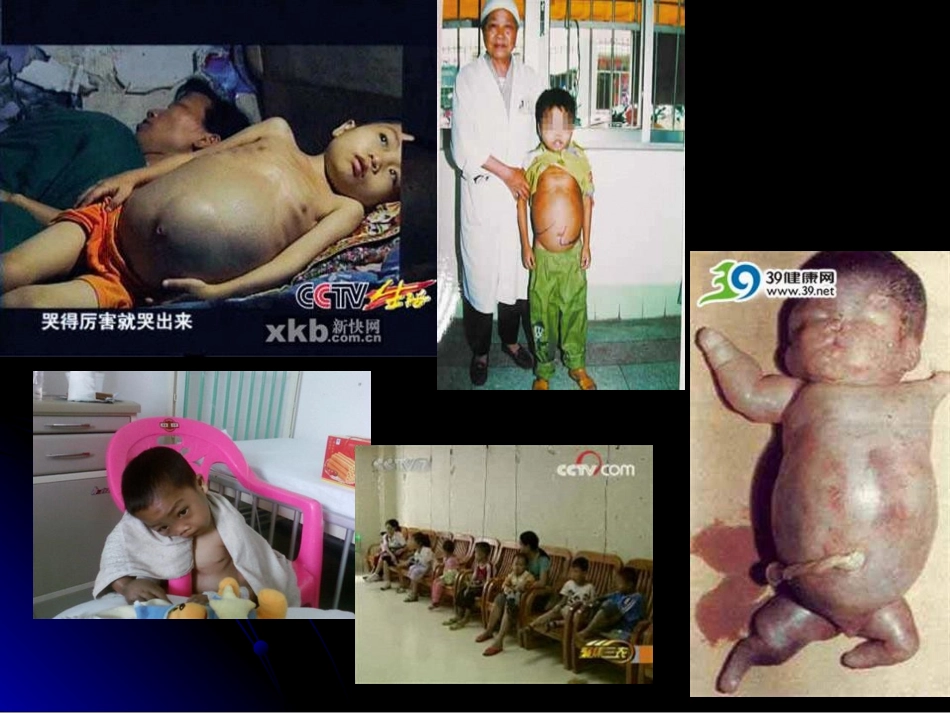 2010地贫讲稿-顺德地贫协会_第2页