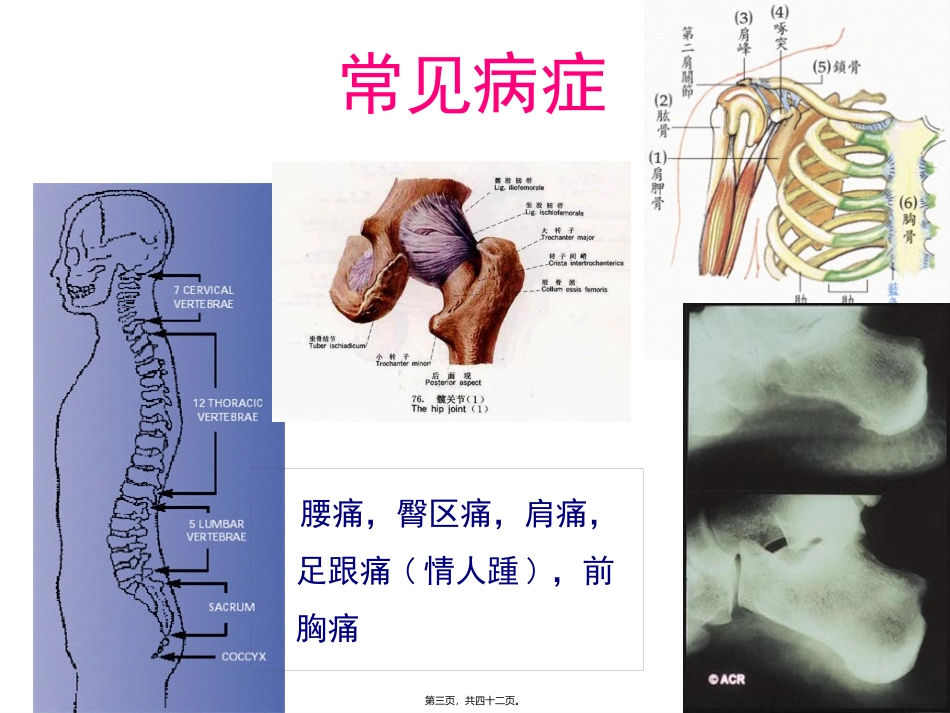 AS髋关节受累的思考_第3页