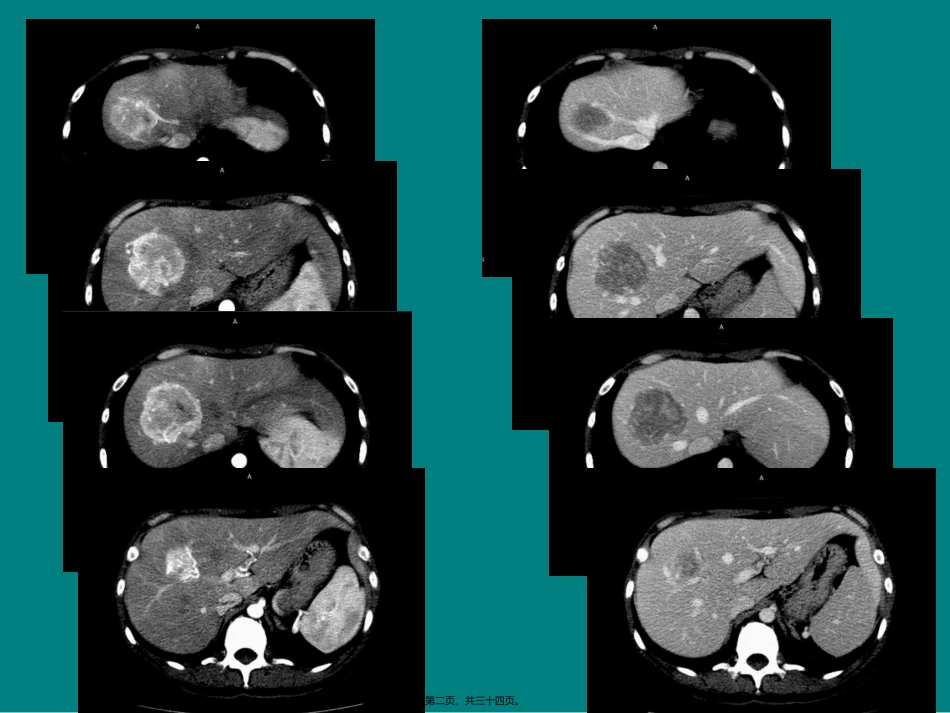 IMT炎性肌纤维母细胞瘤_第2页
