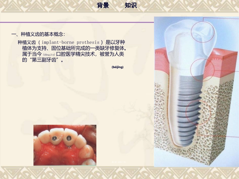 2022年医学专题—最新：牙种植体颈部骨吸收和平台转换技术研究进展-文档资料_第2页