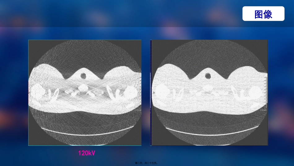 SN100在胸部低剂量的应用_第2页