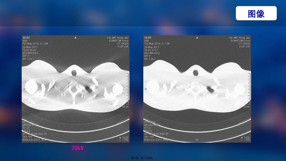SN100在胸部低剂量的应用_第3页