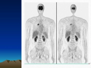2022年医学专题—最新PET病例-PPT文档