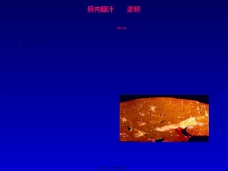 2022年医学专题—最新肝内胆汁淤积-武汉-PPT文档