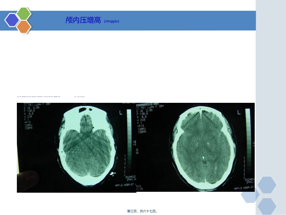 2022年医学专题—最新新版颅内压增高病例PPT-PPT文档_第3页