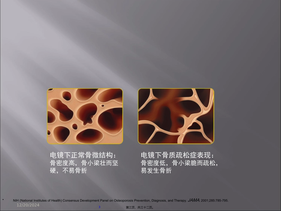 COPD合并骨质疏松症_第3页