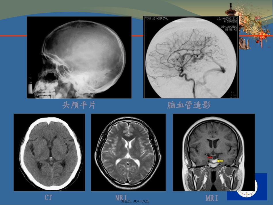 CT-MRI颅脑影像看片_第3页