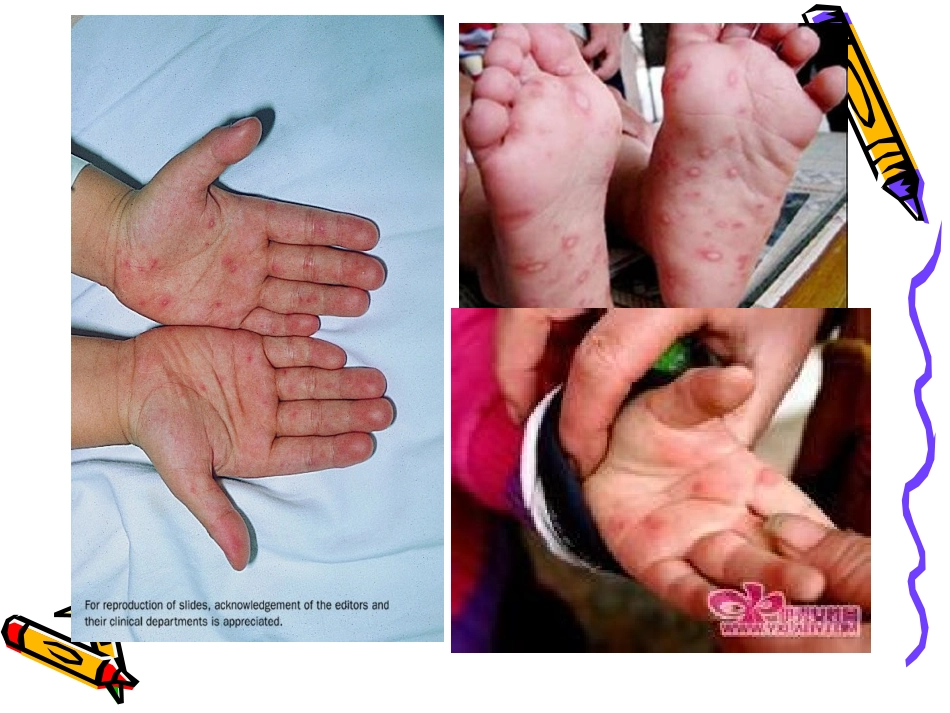 预防手足口病(2)_第3页