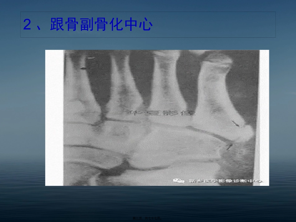 下肢骨影像常见变异_第3页