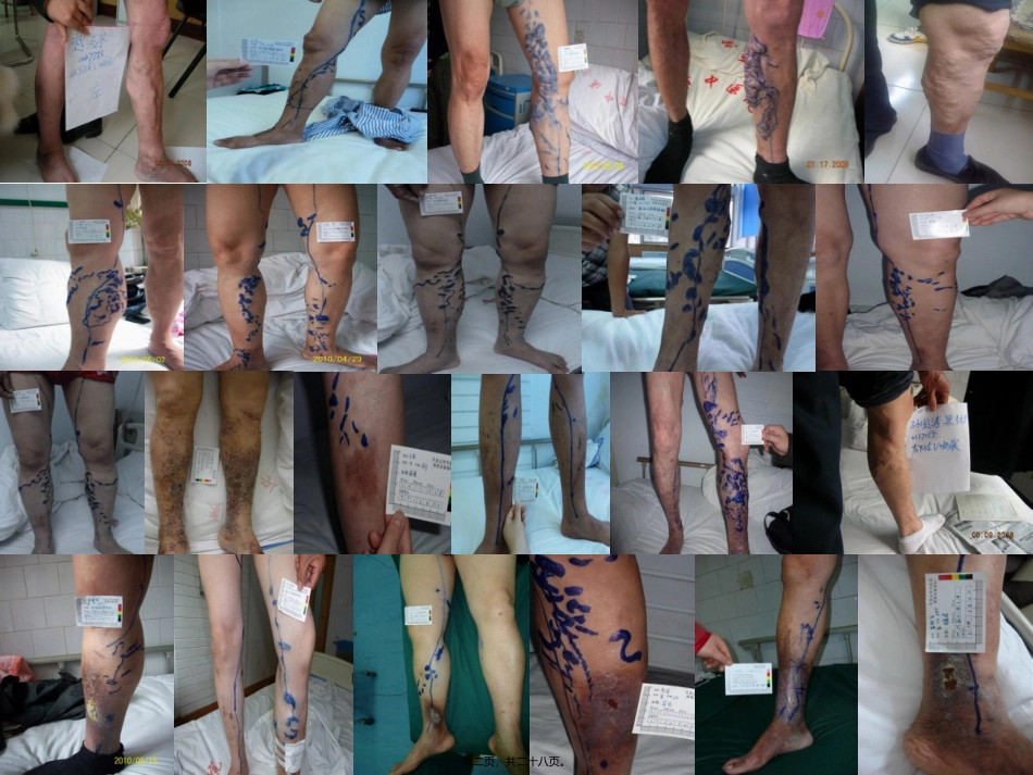 下肢静脉曲张.ppt_第2页