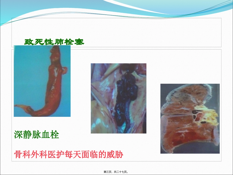 下肢深静脉栓塞_第3页